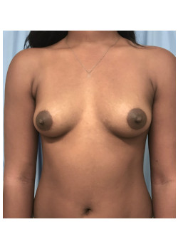 Breast Augmentation Patient 76