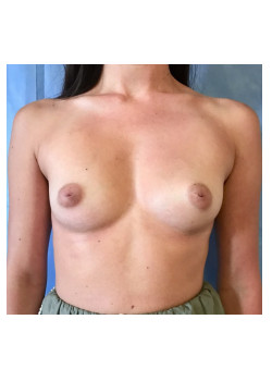 Breast Augmentation Patient 77