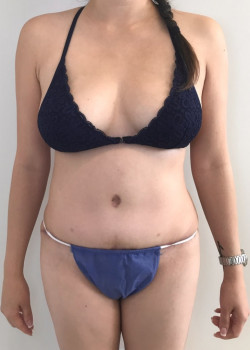 Full Abdominoplasty, Patient 1