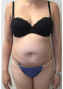 Full Abdominoplasty, Patient 1