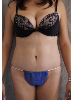 Full Abdominoplasty, Patient 4
