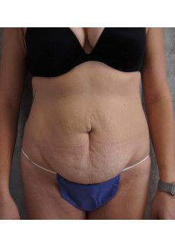 Full Abdominoplasty, Patient 4