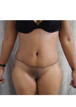 Full Abdominoplasty, Patient 5