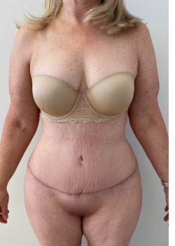 Full Abdominoplasty, Patient 7