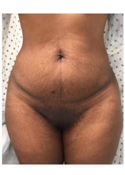 Full Abdominoplasty, Patient 8