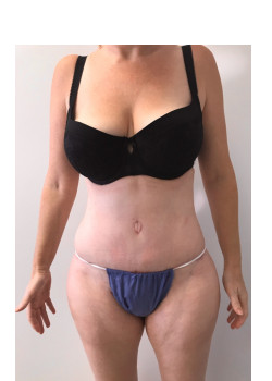 Full Abdominoplasty, Patient 13