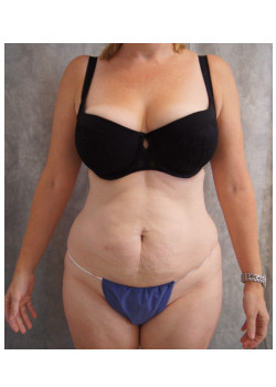 Full Abdominoplasty, Patient 13