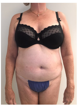 Full Abdominoplasty, Patient 15