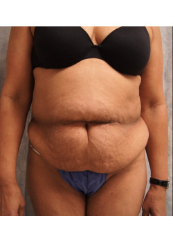 Full Abdominoplasty, Patient 16