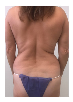 Full Abdominoplasty, Patient 18