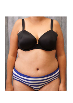 Full Abdominoplasty, Patient 19