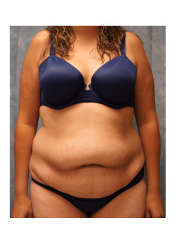 Full Abdominoplasty, Patient 19