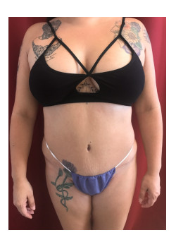 Full Abdominoplasty, Patient 20