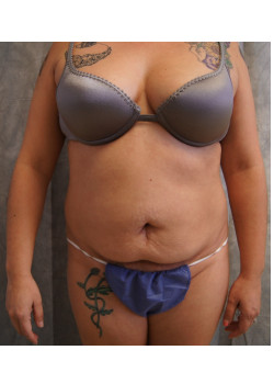 Full Abdominoplasty, Patient 20