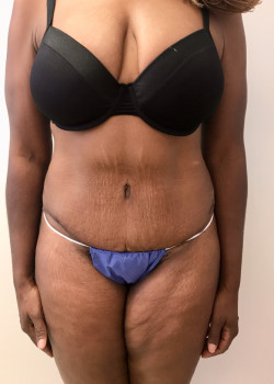 Full Abdominoplasty, Patient 21