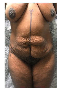 Full Abdominoplasty, Patient 21