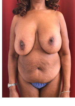 Full Abdominoplasty, Patient 22