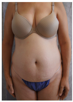 Before & After Abdominoplasty 24 Photos