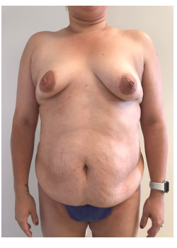Full Abdominoplasty, Patient 25