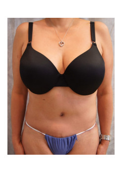Full Abdominoplasty, Patient 26,  Correction of botched Liposuction.