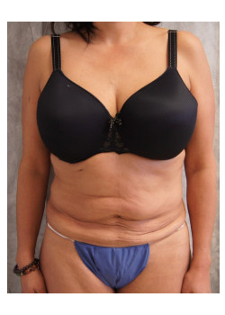 Full Abdominoplasty, Patient 26,  Correction of botched Liposuction.