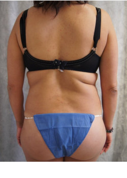 Full Abdominoplasty, Patient 26,  Correction of botched Liposuction.