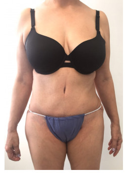 Full Abdominoplasty, Patient 32, with correction of botched Liposuction.