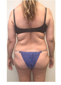 Full Abdominoplasty, Patient 32, with correction of botched Liposuction.