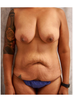 Mommy Makeover, Patient 5