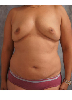 Mommy Makeover, Patient 10