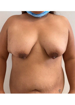 Mastopexy, Patient 1