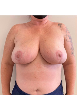 Mastopexy, Patient 4