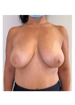 Mastopexy, Patient 9