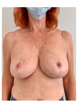 Mastopexy, Patient 13