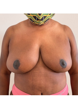 Mastopexy, Patient 14