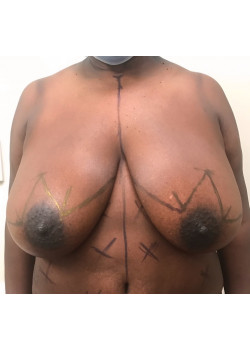 Mastopexy, Patient 14