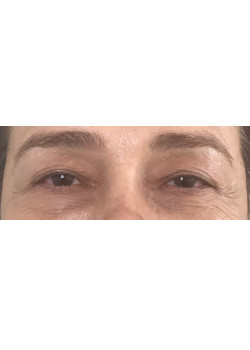Blepharoplasty/Eyelift, Patient 1