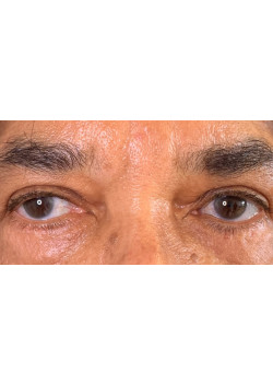 Blepharoplasty/Eyelift, Patient 2