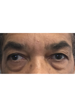 Blepharoplasty/Eyelift, Patient 2