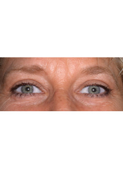 Blepharoplasty/Eyelift, Patient 3