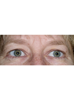 Blepharoplasty/Eyelift, Patient 3