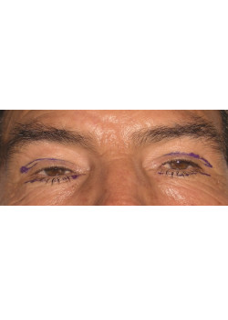 Blepharoplasty/Eyelift, Patient 4