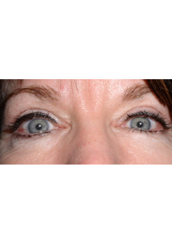 Blepharoplasty/Eyelift, Patient 5