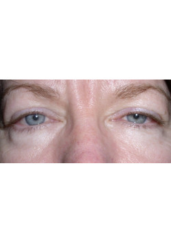 Blepharoplasty/Eyelift, Patient 5