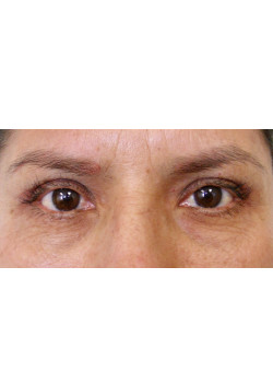 Blepharoplasty/Eyelift, Patient 6