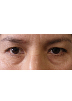 Blepharoplasty/Eyelift, Patient 6