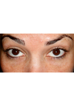 Blepharoplasty/Eyelift, Patient 8