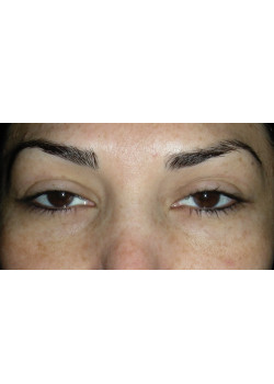 Blepharoplasty/Eyelift, Patient 8