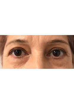 Blepharoplasty/Eyelift, Patient 9