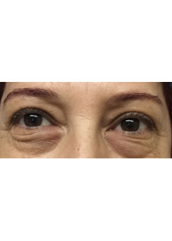 Blepharoplasty/Eyelift, Patient 9